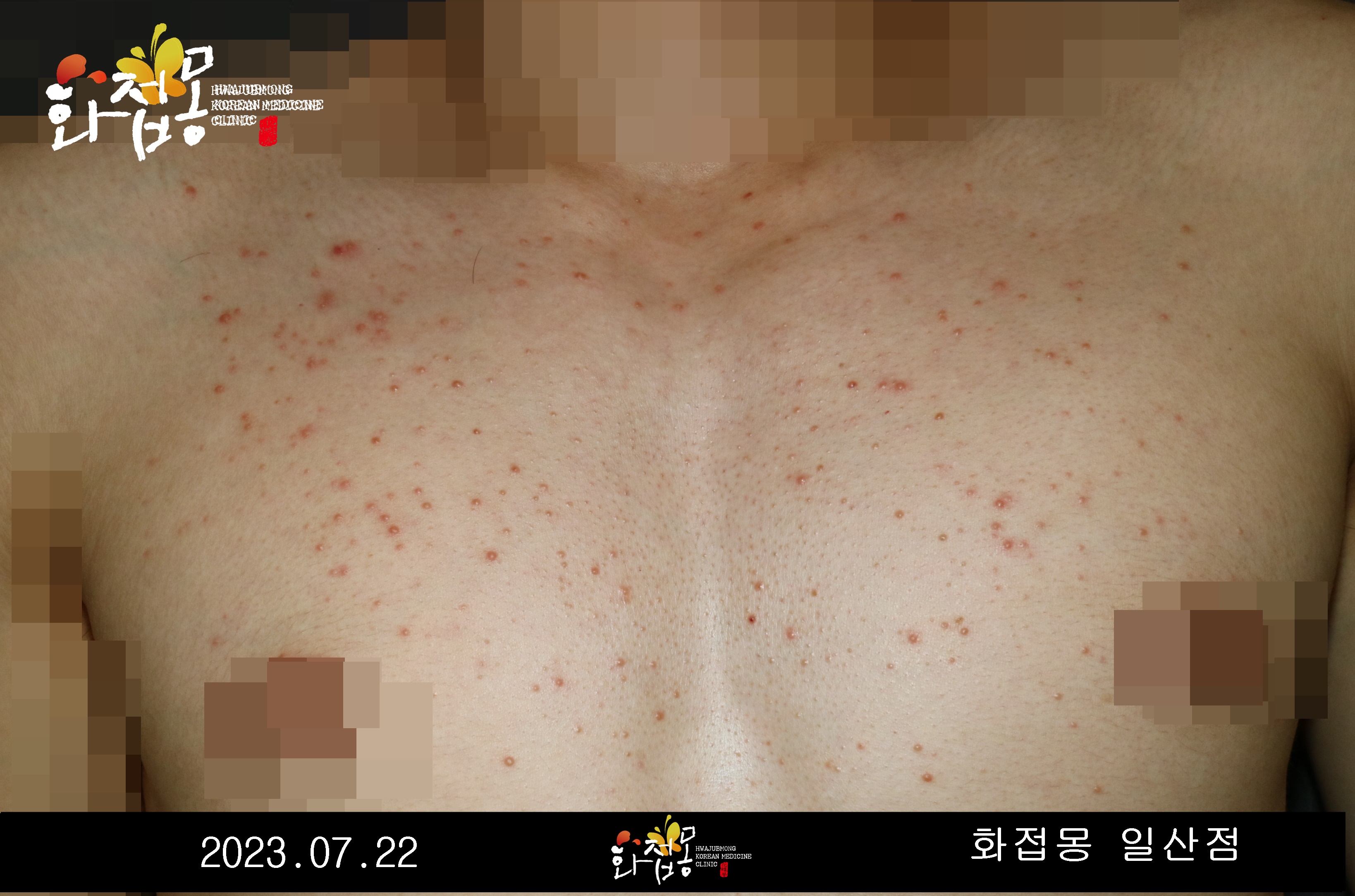 전후사진