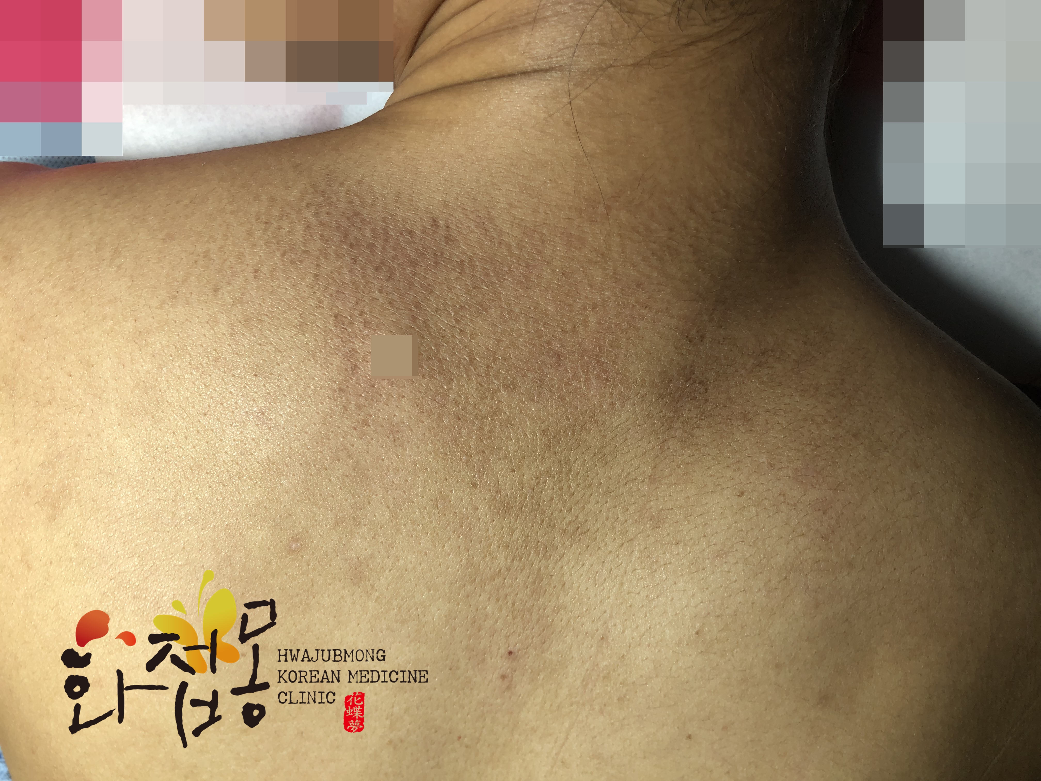 전후사진