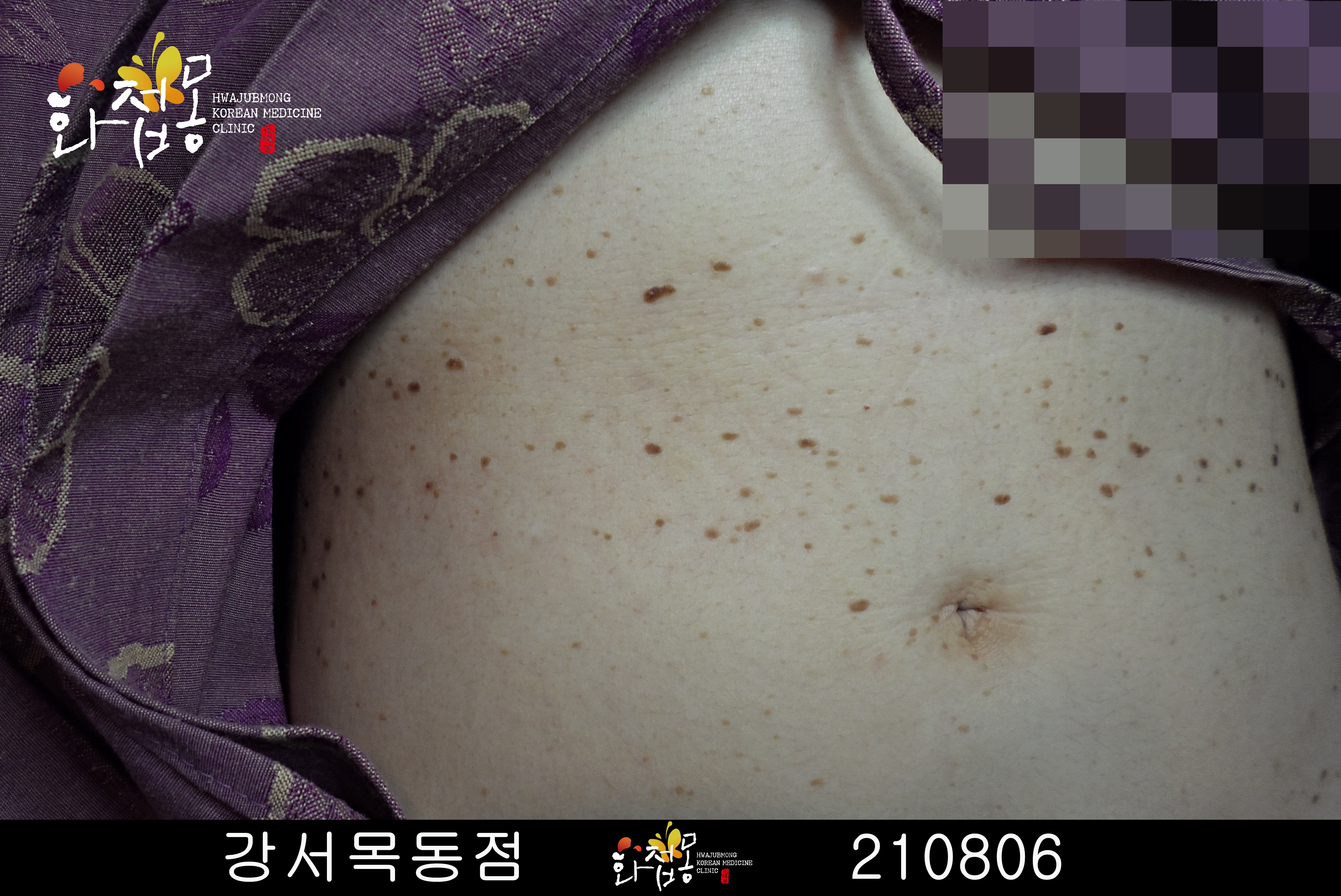 전후사진