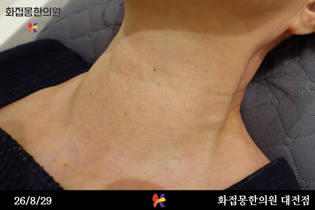 전후사진