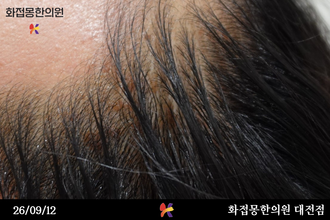 전후사진