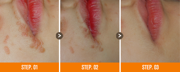 화접몽한의원 편평사마귀 전후사진