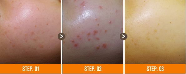 화접몽한의원 편평사마귀 전후사진