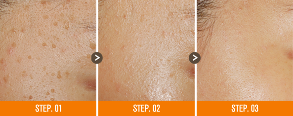 화접몽한의원 편평사마귀 전후사진