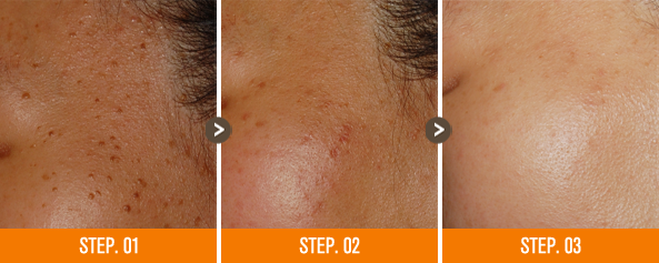 화접몽한의원 편평사마귀 전후사진