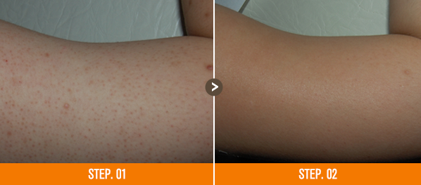 화접몽한의원 모공각화증 전후사진