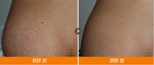 화접몽한의원 모공각화증 전후사진