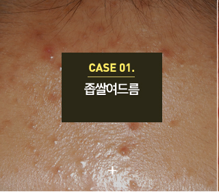 여드름
