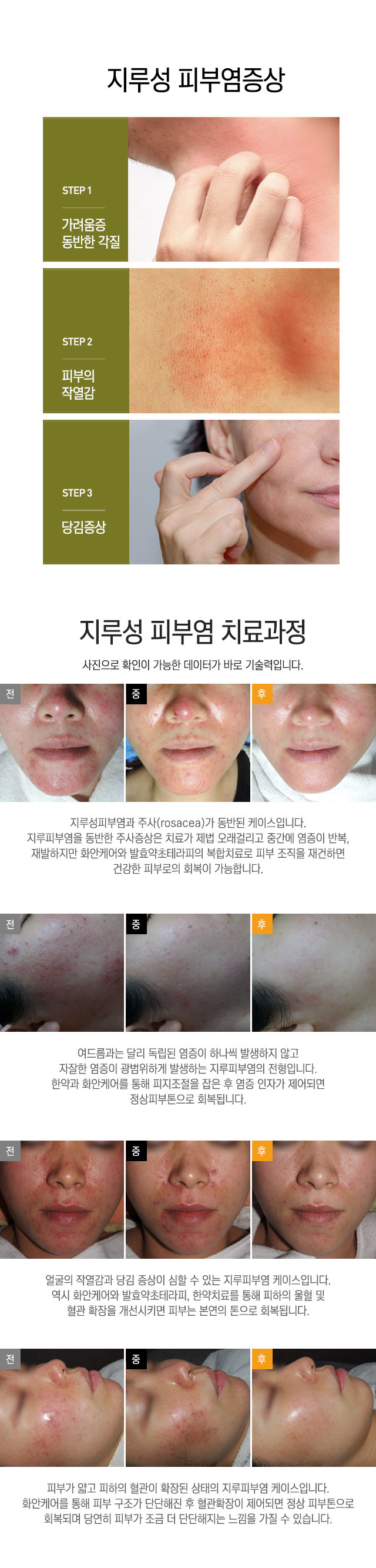 지루성피부염