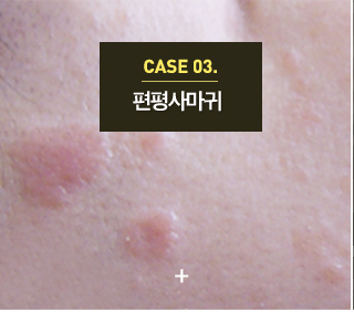 사마귀