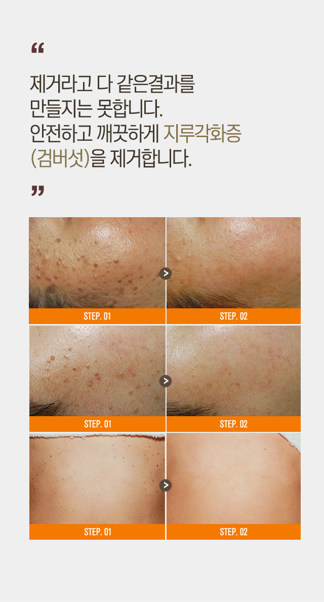 지루각화증(검버섯)