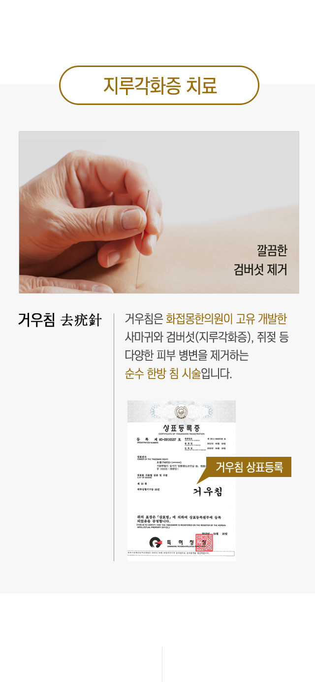 지루각화증(검버섯)