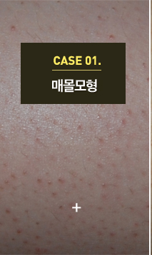 모공각화증