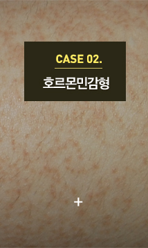 모공각화증