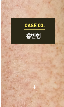 모공각화증